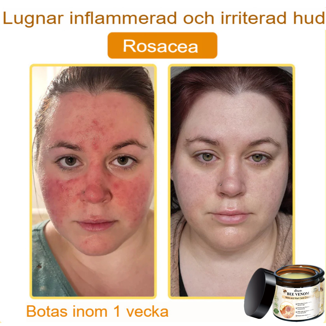 SkinClear | Bivene Behandlingskräm för Vårtor och Molar
