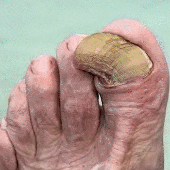 NailCare™ | Beende Nagelschäden für immer