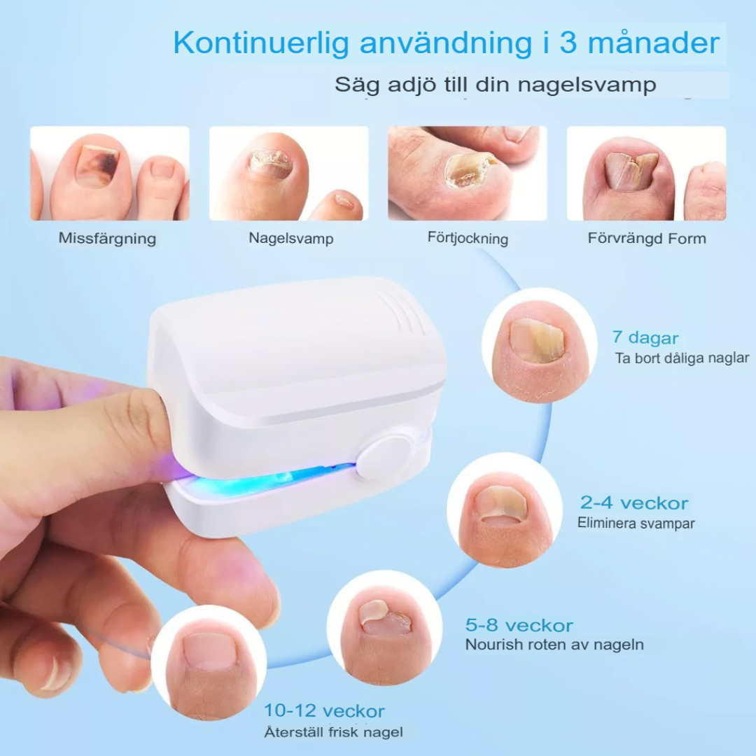 Avancerad Laserbehandling för Nagelsvamp | Snabb och Effektiv