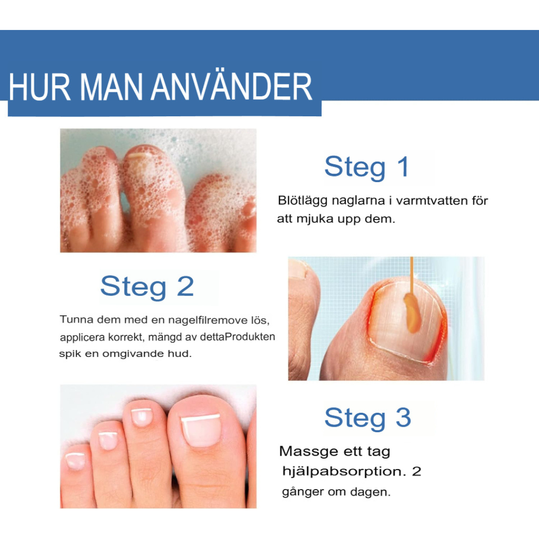 TotalCare Nagelsvampbehandling för Tånaglar | Effektiv Nagelåterställning & Vård