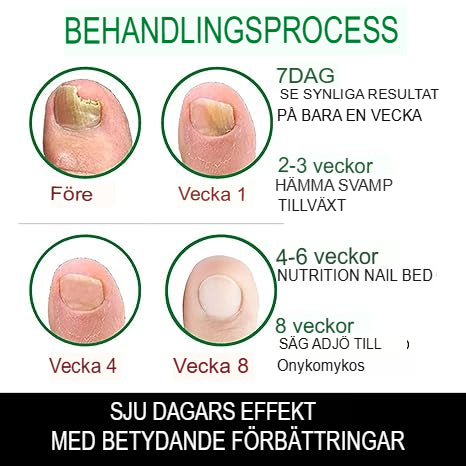 7 Dagars Ingefära Nagelsvampbehandling | Helt Naturligt Antisvamp-Serum för Hand- och Fotvård