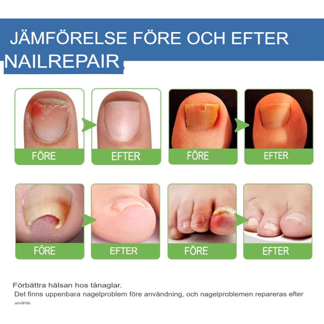 TotalCare Nagelsvampbehandling för Tånaglar | Effektiv Nagelåterställning & Vård