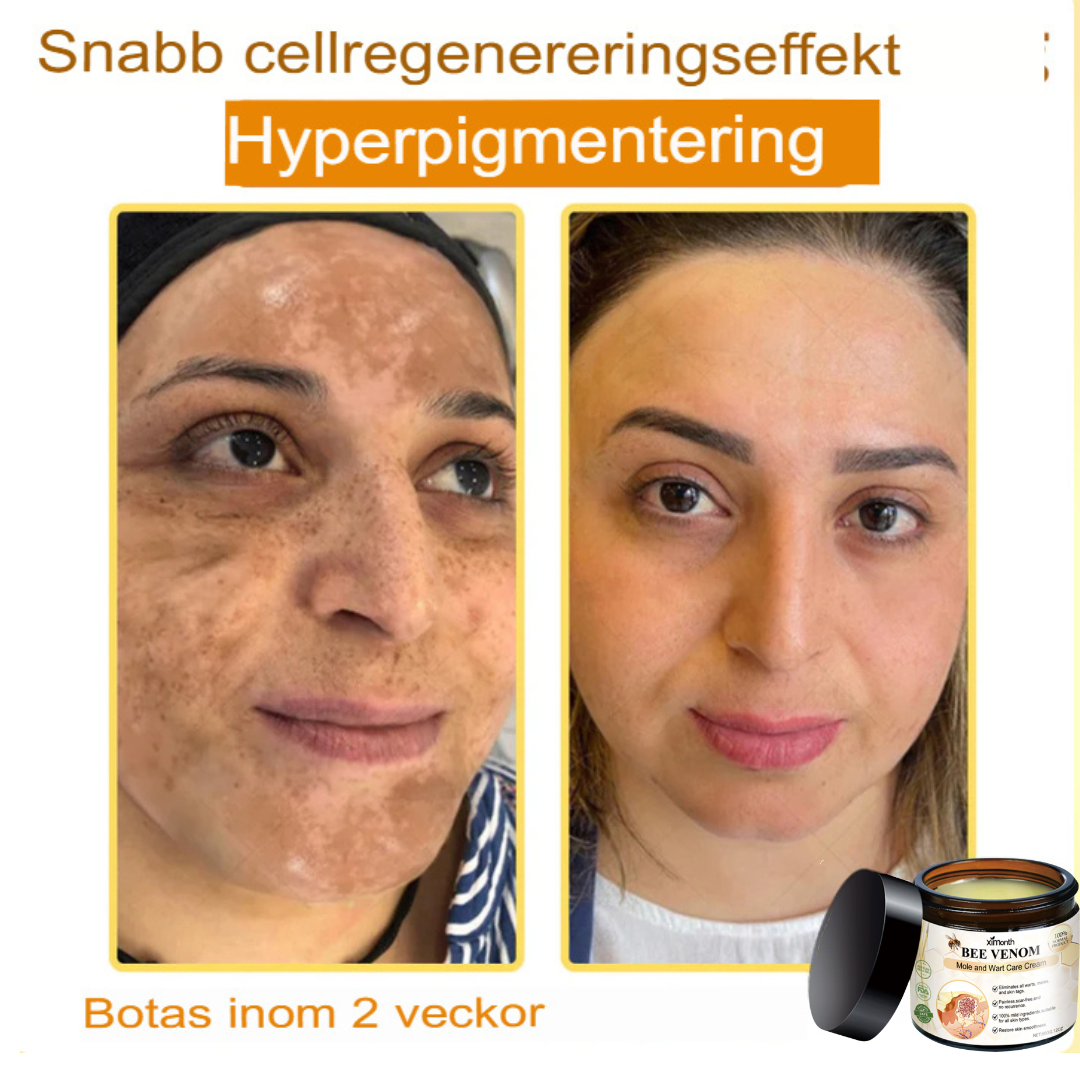SkinClear | Bivene Behandlingskräm för Vårtor och Molar