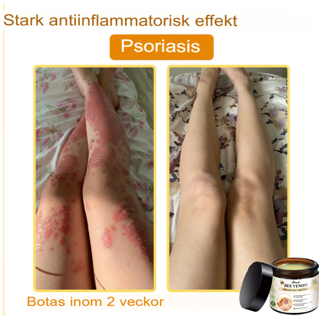 SkinClear | Bivene Behandlingskräm för Vårtor och Molar