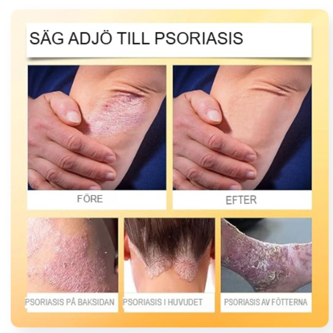 BeeSooth - Psoriasis Lindringsspray | Snabbverkande Biveneformel