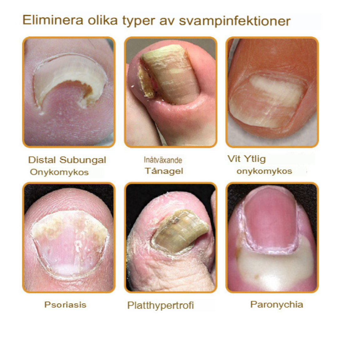 Bee Venom Behandlingsserum för Nagelsvamp | Snabbverkande, Långvarig Lättnad