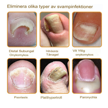 Bee Venom Behandlingsserum för Nagelsvamp | Snabbverkande, Långvarig Lättnad