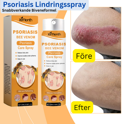BeeSooth - Psoriasis Lindringsspray | Snabbverkande Biveneformel