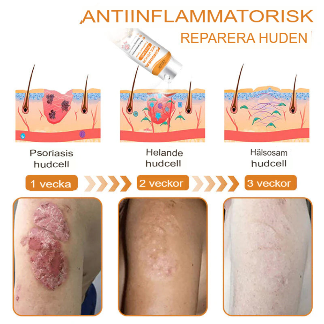 BeeSooth - Psoriasis Lindringsspray | Snabbverkande Biveneformel