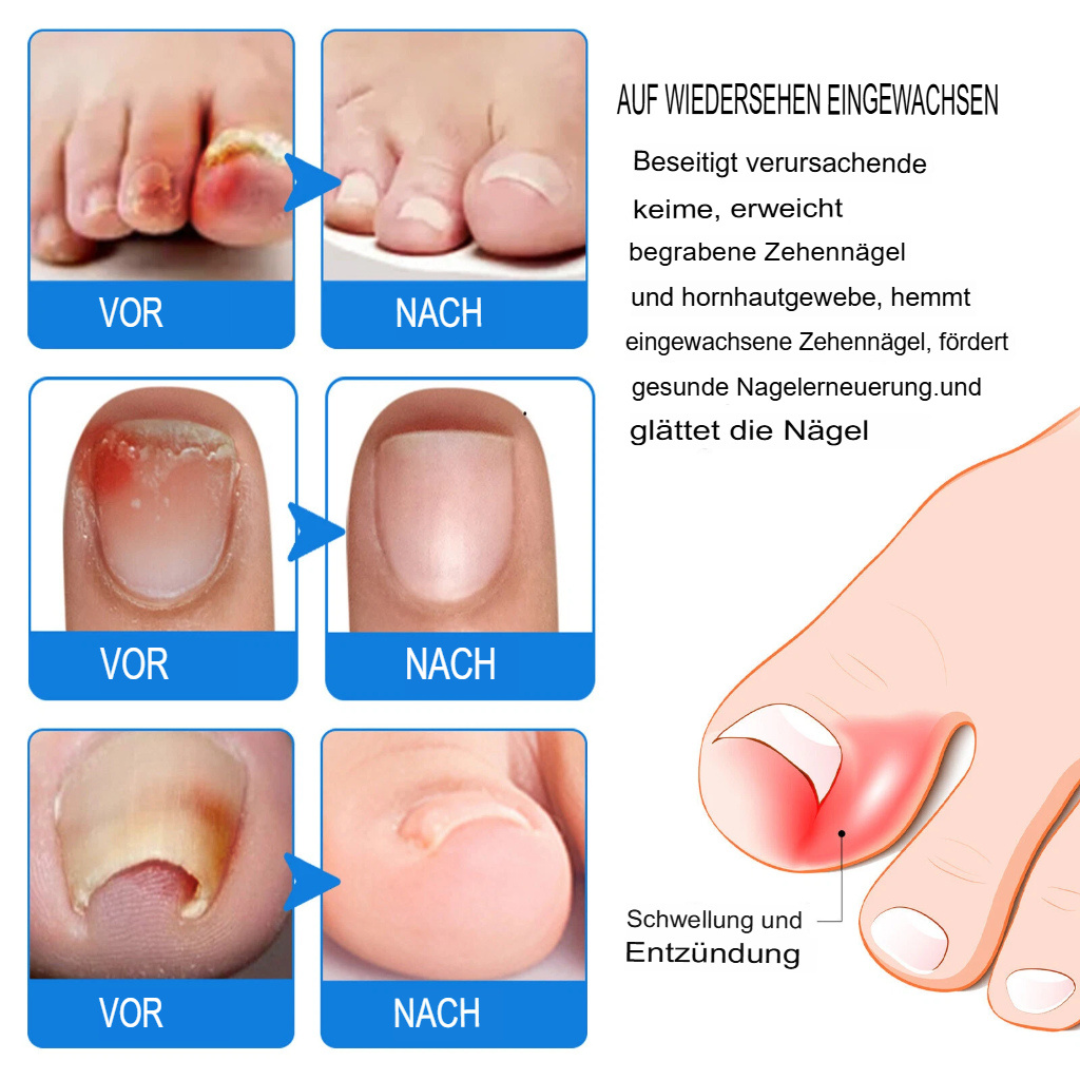 Fungex | Nagelpilz-Creme – Schnelle & Schmerzfreie Hilfe!