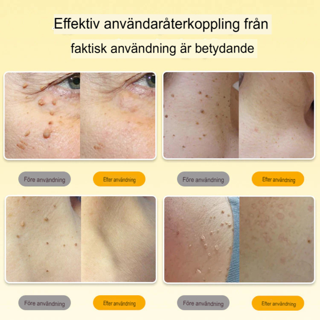 Bee Venom Taggborttagningsspray | Snabb Lösning för Hudflikar