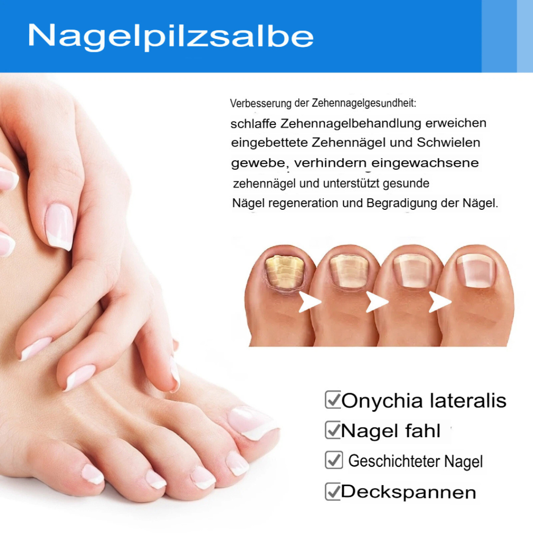 Fungex | Nagelpilz-Creme – Schnelle & Schmerzfreie Hilfe!