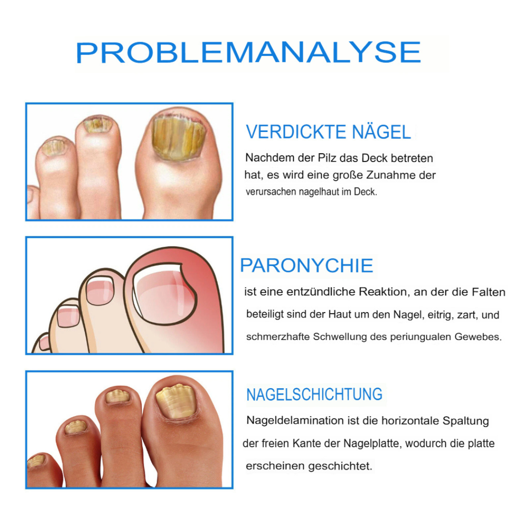 Fungex | Nagelpilz-Creme – Schnelle & Schmerzfreie Hilfe!