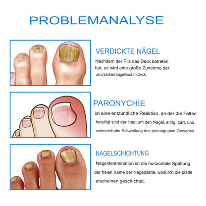 Fungex | Nagelpilz-Creme – Schnelle & Schmerzfreie Hilfe!